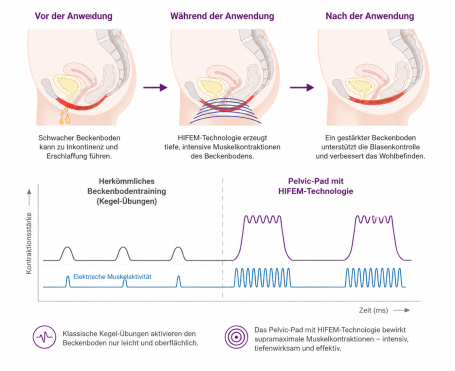 Beckenbodentraining für Zuhause Neo Pelvic